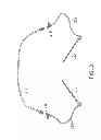Fig. 09 - System and methods for controlling retrograde carotid arterial blood flow