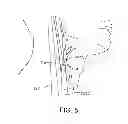 Fig. 11 - System and methods for controlling retrograde carotid arterial blood flow