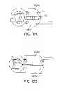 Fig. 20 - System and methods for controlling retrograde carotid arterial blood flow