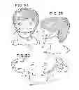 Fig. 15 - Oral mouthpiece and method for the use thereof