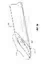 Fig. 33 - Catheter placement device and method