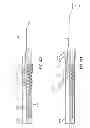 Fig. 41 - Catheter placement device and method