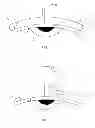 Fig. 02 - Intrascleral drug delivery device and associated methods
