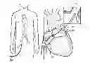Fig. 01 - System, device and method for ablation of a vessel's wall from the inside