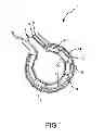 Fig. 02 - Apparatus and method for cooling and moving ablation elements