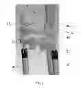 Fig. 04 - Method for treating a fracture of a bone having a medullary canal
