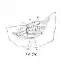 Fig. 22 - SYSTEM AND METHOD FOR ANTERIOR APPROACH FOR INSTALLING TIBIAL STEM