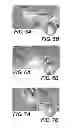 Fig. 06 - Endoscopic surgical blade and method of use thereof