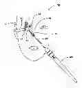 Fig. 01 - Devices and methods for Dilating a Eustachian Tube