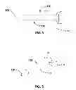Fig. 04 - Devices and methods for Dilating a Eustachian Tube
