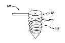Fig. 01 - PARTIAL THICKNESS ROTATOR CUFF REPAIR SYSTEM AND METHOD