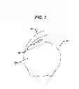 Fig. 02 - PARTIAL THICKNESS ROTATOR CUFF REPAIR SYSTEM AND METHOD