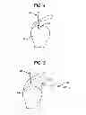 Fig. 04 - PARTIAL THICKNESS ROTATOR CUFF REPAIR SYSTEM AND METHOD