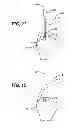 Fig. 08 - PARTIAL THICKNESS ROTATOR CUFF REPAIR SYSTEM AND METHOD