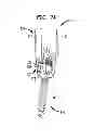 Fig. 07 - Rod contouring method for percutaneous pedicle screw extension
