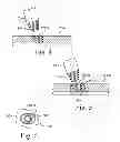 Fig. 04 - Method of reduction of proximal humeral fracture