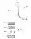 Fig. 06 - Method of reduction of proximal humeral fracture