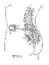Fig. 02 - Minimally invasive methods for implanting a sacral stimulation lead