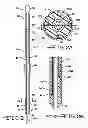 Fig. 03 - Minimally invasive methods for implanting a sacral stimulation lead