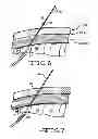 Fig. 06 - Minimally invasive methods for implanting a sacral stimulation lead