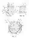 Fig. 02 - Everting transcatheter valve and methods