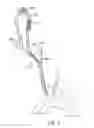 Fig. 05 - SYSTEMS AND METHODS FOR TRANSCERVICAL AORTIC VALVE TREATMENT