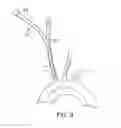 Fig. 07 - SYSTEMS AND METHODS FOR TRANSCERVICAL AORTIC VALVE TREATMENT