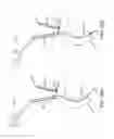 Fig. 13 - SYSTEMS AND METHODS FOR TRANSCERVICAL AORTIC VALVE TREATMENT