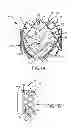 Fig. 02 - Multi-frame prosthetic valve apparatus and methods