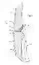 Fig. 06 - Double bundle ACL repair