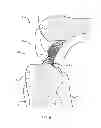 Fig. 07 - Double bundle ACL repair