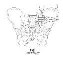 Fig. 02 - Systems for and methods of fusing a sacroiliac joint