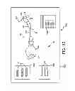 Fig. 86 - Systems for and methods of fusing a sacroiliac joint