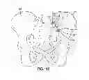 Fig. 89 - Systems for and methods of fusing a sacroiliac joint