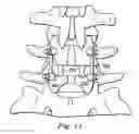 Fig. 08 - INTERBODY SPACER