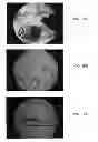 Fig. 08 - Bone graft materials and methods