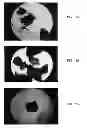 Fig. 09 - Bone graft materials and methods