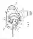 Fig. 05 - Compressible connector for an inner cannula