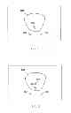 Fig. 02 - WELL CONFIGURATIONS FOR LIMITED REFLUX