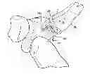 Fig. 01 - Method and apparatus for delivering a shape memory article to a surgical site