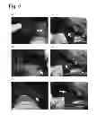 Fig. 07 - Tissue occluding agent comprising an IEIKIEIKIEIKI peptide