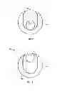 Fig. 07 - Dilation system