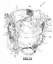 Fig. 02 - Active exoskeletal spinal orthosis and method of orthotic treatment