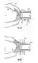 Fig. 04 - Systems for implanting and using a conduit within a tissue wall