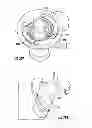 Fig. 30 - Systems for implanting and using a conduit within a tissue wall