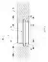 Fig. 02 - Fracture fixation systems having intramedullary support