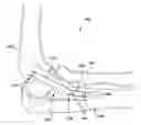 Fig. 01 - METHOD AND APPARATUS FOR PROVIDING A SOFT-TISSUE TRANSPLANT TO A RECEIVING BONE