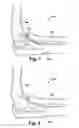 Fig. 02 - METHOD AND APPARATUS FOR PROVIDING A SOFT-TISSUE TRANSPLANT TO A RECEIVING BONE