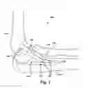 Fig. 06 - METHOD AND APPARATUS FOR PROVIDING A SOFT-TISSUE TRANSPLANT TO A RECEIVING BONE