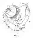 Fig. 07 - Package for an implantable neural stimulation device